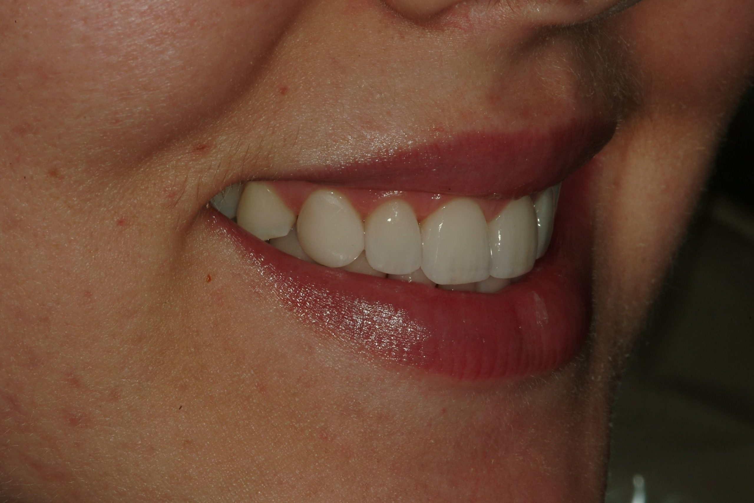 After Dental Treatment