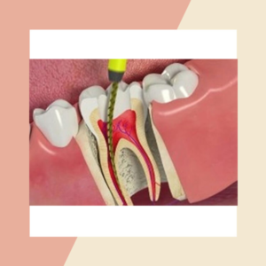 Root Canal Treatment in Dallas tx