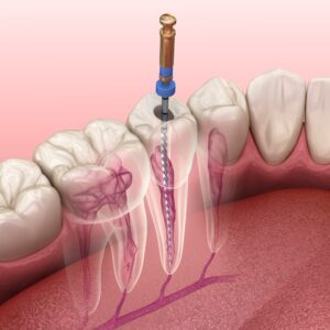 Why is Root Canal Treatment Important?
