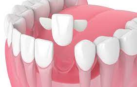 Alternatives to Dental Implants