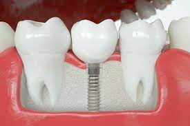 Dental Implants Vs Dental Crowns: The Differences