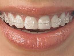 Which Type Of Braces Work Faster?